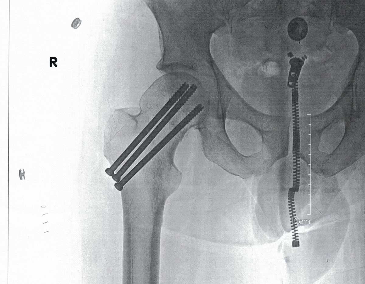 hip-screws.jpg
